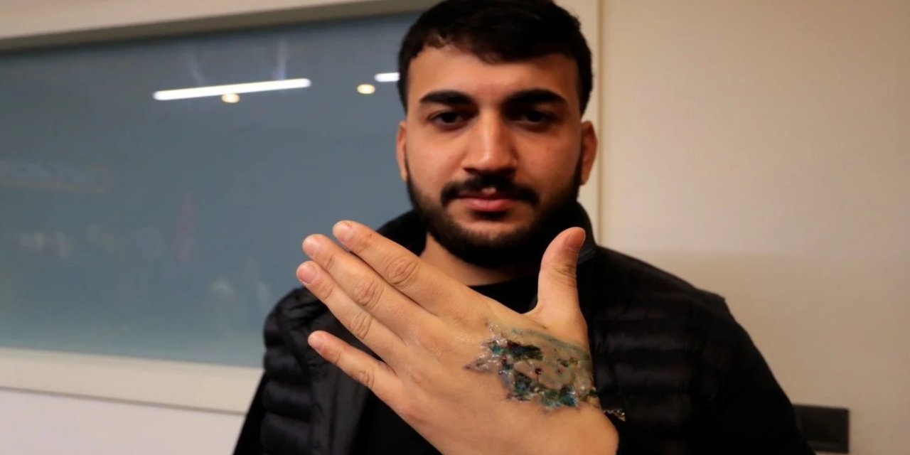 Dövmesini sildirmek isterken dokularını kaybetti