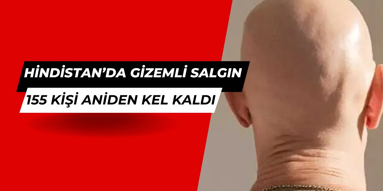 Hindistan'a gizemli salgın: 155 kişi aniden kel kaldı